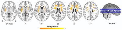 Improving Depressive Symptoms of Post-stroke Depression Using the Shugan Jieyu Capsule: A Resting-State Functional Magnetic Resonance Imaging Study